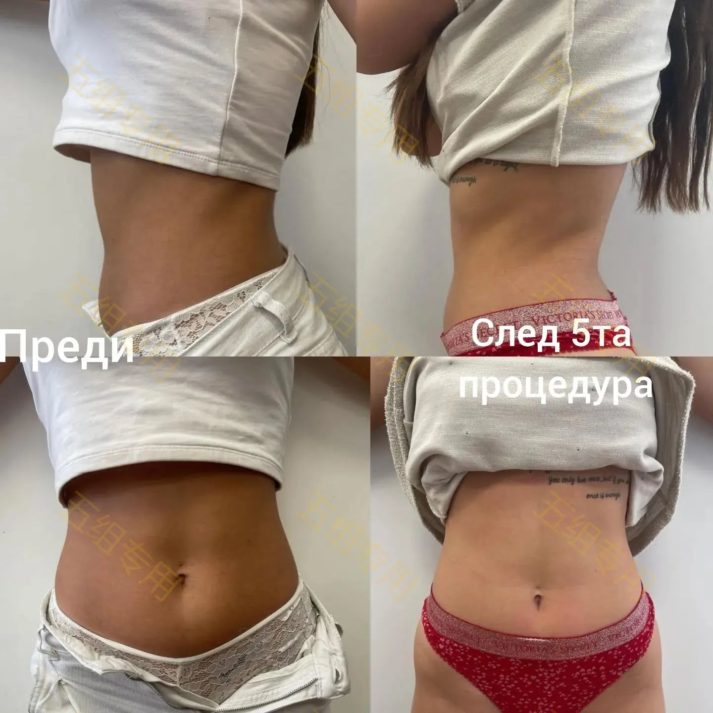 Myoslim EMS RF Vacuum Inner Ball Roller for Cellulite